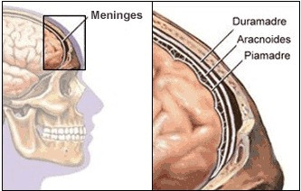 meningitis