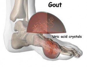 Asam Urat atau Gout Arthritis