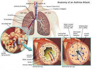 asthma
