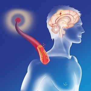 Cepat Bertindak Menyelamatkan Pasien Stroke