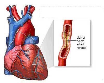 Diet Puasa Penderita Penyakit Jantung Koroner