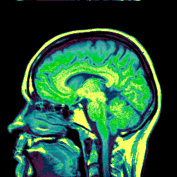 Penggunaan Ponsel Berisiko Tumor Otak