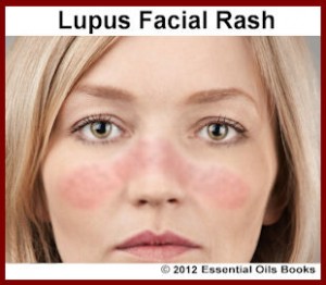 Lupus