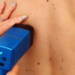 HG064_man-back-treating-melanoma_FS