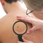 melanoma-research