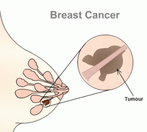 Breast_cancer