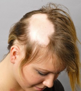 alopeciaareata