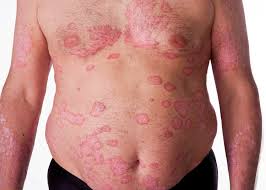 Protein Penyebab Psoriasis Ditemukan