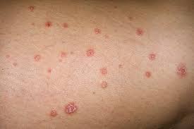 Makanan yang Baik dan Buruk Untuk Penderita Psoriasis