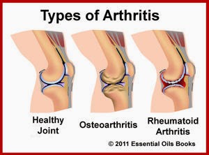 9 Makanan yang Bersahabat Dengan Arthritis