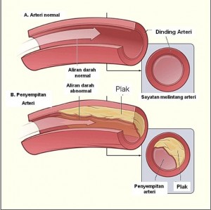 diagram_aterosklerosis