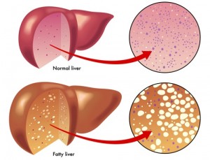 Jangan Sepelekan Fatty Liver