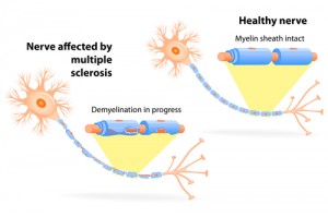 Kekurangan Vitamin B12 Dan Vitamin D Dapat Menyebabkan Multiple Sclerosis