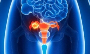 Gen BRIP1 Berhubungan Dengan Peningkatan Resiko Kanker Ovarium