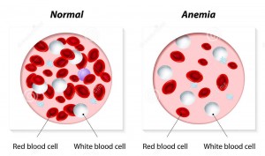 anemia