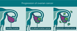 Progression_ovarianCancer1