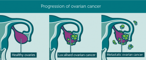 Mengenal Kanker Ovarium