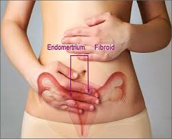 endometriosis