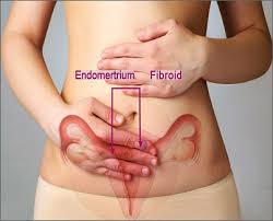Risiko Tinggi Terhadap Penyakit Jantung pada Wanita dengan Endometriosis