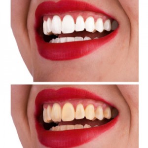 icky-teeth-400x400