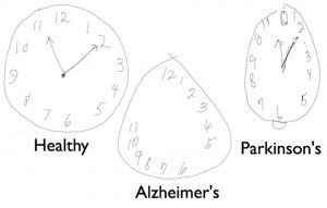 Penderita Alzheimer dan Parkinson Tidak Terbukti Menularkan Penyakitnya Melalui Darah