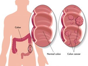 bigstock-colon-cancer-61575257