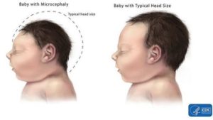 Mikrosefali (Kepala Bayi Mengecil) Bukan Satu-Satunya Tanda Infeksi Virus Zika