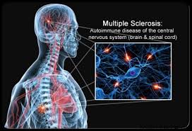 penyakit-multiple-sclerosis