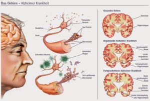 Berbagai Gejala Penyakit Alzheimer