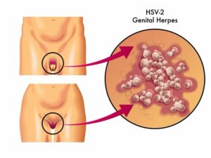 Gejala Herpes Genital Yang Perlu Diketahui