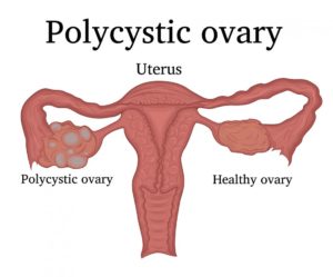 Polycystic Ovary Syndrome (PCOS) dan Risiko Diabetes