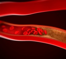 Arteriosklerosis dan Atheroskeloris
